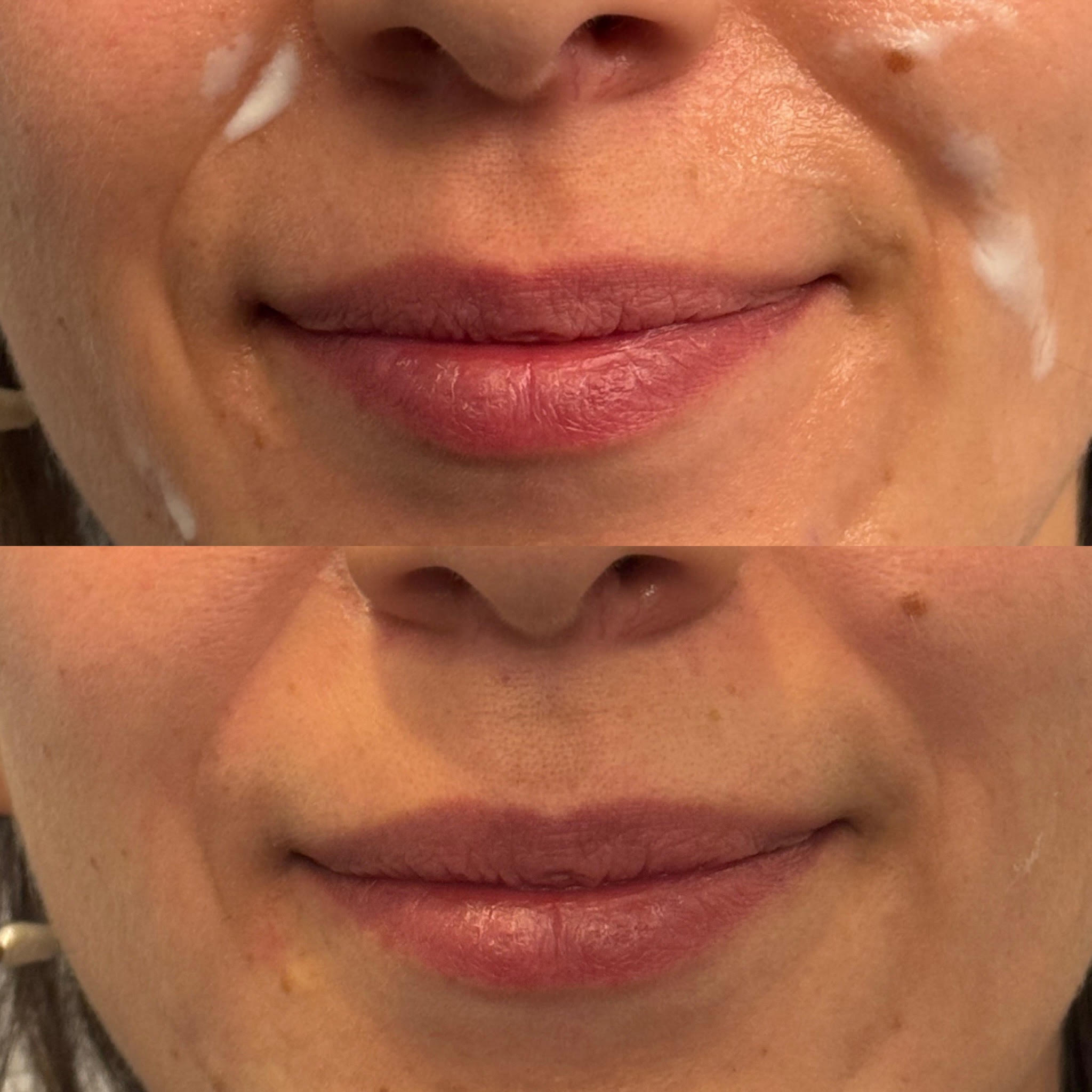 Nasolabial Fold Filler - Before & After